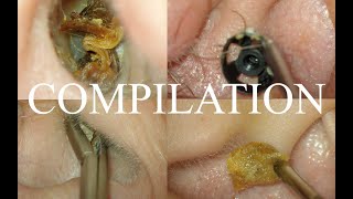 4 CASES  SEVERE EAR  COUGH REFLEX  CERUMEN IMPACTION  FOREIGN BODY  SYNDROMIC EARS [upl. by Ahseek616]