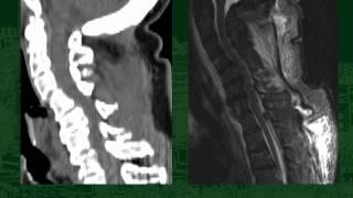 Cervical Spine Clearance in the Traumatically Injured Patient Is CT Scan Sufficient Alone [upl. by Onnem]