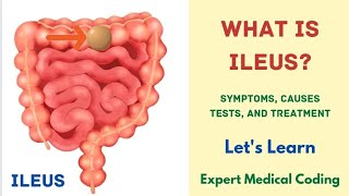 What is Ileus  Symptoms  Causes  Complications  Tests  Treatment Precautions Medical Coding [upl. by Muna]