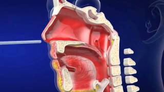 Nasogastric eLearning from Vygon UK Ltd [upl. by Duhl]