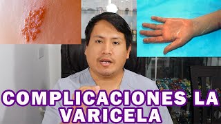 COMPLICACIONES DE LA VARICELA  DR APARI [upl. by Netsew972]