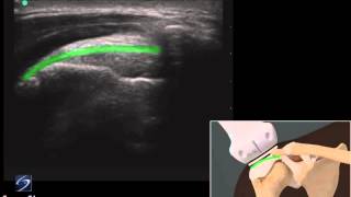 Démo 3D  échographie dune tendinite de la coiffe des rotateurs  Échographe SonoSite [upl. by Nydroj]