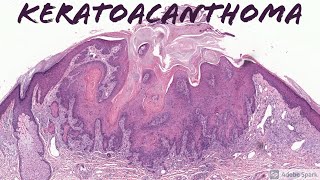 Keratoacanthoma 5Minute Pathology Pearls [upl. by Voleta]