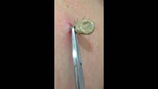 Tick removal by US doctor [upl. by Elleinwad]