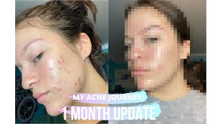 MY ACNE JOURNEY  MONTH 1 ON SPIRONOLACTONE [upl. by Leahcimrej754]