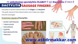 DactylitisSausage fingers realated Autoimmune disease HLAB27 CausesSymptomsHomeopathic Medicine [upl. by Avivah828]