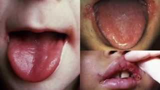 Angular Cheilitis Treatment  How to Get Rid of Angular Cheilitis in 24 hours [upl. by Dloreh]