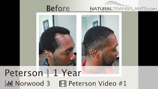 1 Year Check In with Norwood 3 Patient Incredible Results  Dr Siegel Peterson [upl. by Denise]