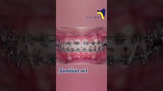 From Misaligned to Magnificent The Miracle of Modern Orthodontics orthodonticsbrace orthodontist [upl. by Grous]