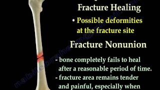 Fracture Healing Part 1  Everything You Need To Know  Dr Nabil Ebraheim [upl. by Nehtanoj]