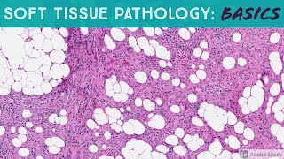 Basic Soft Tissue Pathology Cases Explained by a Sarcoma Pathologist [upl. by Gnilyam]