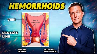 The 1 Best Remedy for Hemorrhoids  Dr Berg [upl. by Nylle33]