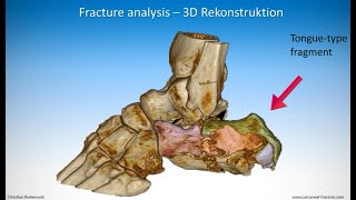 Technique of minimalinvasive treatment on a calcaneal fracture  Tonguetype [upl. by Serra704]