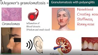 Wegeners granulomatosis  Granulomatosis with polyangiitis  Symptoms and causes [upl. by Ahseinad]