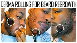 Microneedling for Beard Growth  30 Day Results [upl. by Ttelrahc]