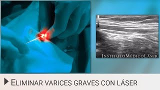 Eliminar varices con Láser Endovenoso [upl. by Aihseuqram]