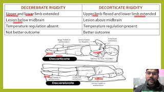 DIFFERENCE BETWEEN DECEREBRATE AND DECORTICATE RIGIDITY DECORTICATERIGIDITY DECEREBRATERIGIDITY [upl. by Flower]