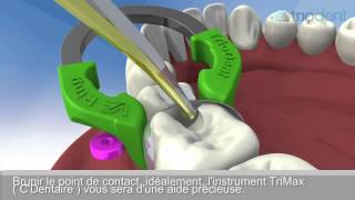 TRIODENT V3 SYSTEME MATRICE PROTOCOLE [upl. by Canale]