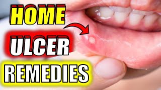 19 Fast amp Effective MOUTH ULCER Home Remedies CANKER SORES [upl. by Nilrah]