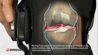 Learn About Knee Osteoarthritis OA [upl. by Limaj793]