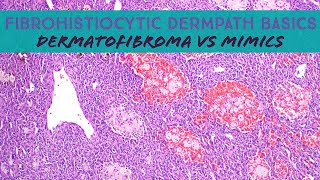 Fibrohistiocytic Dermpath Basics  dermatofibroma amp mimics dermatology dermatopathology pathology [upl. by Havstad]