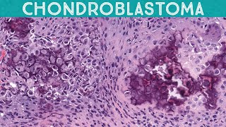 Chondroblastoma with perfect chickenwire calcification Bone pathology basics Yale case 7 [upl. by Boyden]