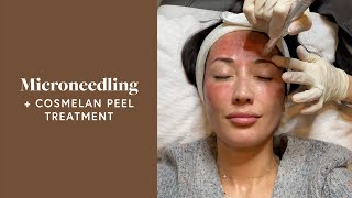 Microneedling Treatment amp Cosmelan Peel For My Melasma  Susan Yara [upl. by Randal555]