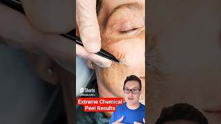 Ultimate CHEMICAL PEEL  Extreme Skin Peel Results shorts [upl. by Aon]