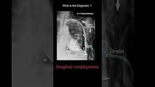 Surgical emphysema 200 chest Xray tubes Quiz radiologychannel007 [upl. by Llerdnek]