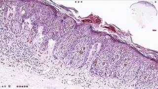 Superficial Spreading Melanoma  Histopathology [upl. by Ketchan150]