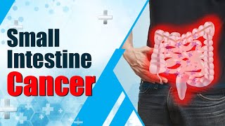 Health Talk Small Intestine Cancer  Symptoms amp Treatment  TUBERS [upl. by Naivad]