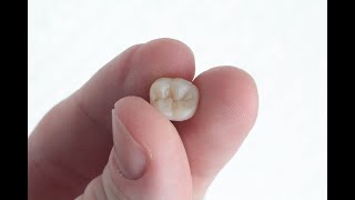 1st Lower Molar  Composite [upl. by Patnode]