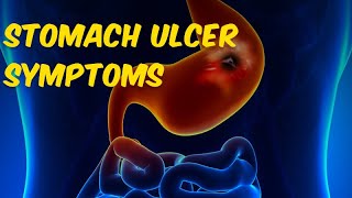 Stomach Ulcer Symptoms What Are the Warning Signs of an Ulcer [upl. by Narba]