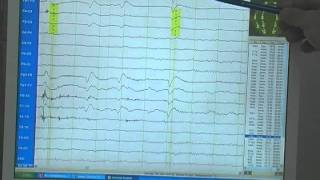 EEG  Die Elektroenzephalografie [upl. by Haleemaj]