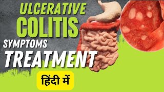 Ulcerative colitis symptoms and treatment  Inflammatory bowel disease [upl. by Ardnaz]