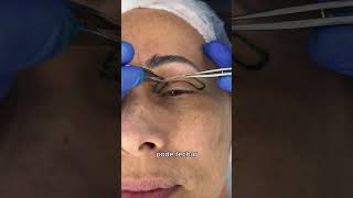 Explicando a Blefaroplastia superior [upl. by Hernardo]