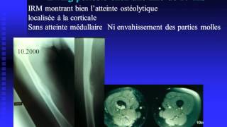 Diagnostic et classifications actuelles des sarcomes osseux du genou [upl. by Dinin769]