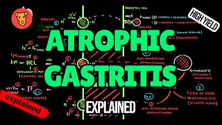 ATROPHIC GASTRITIS Pathogenesis Diagnostic criteria Treatment [upl. by Leifer52]