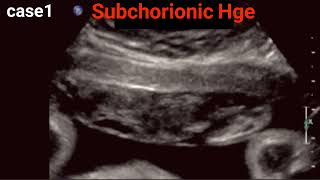 Abruptio Placentae  Ultrasound Basics [upl. by Clemente216]