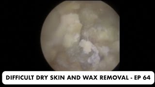 DIFFICULT DRY SKIN AND EAR WAX REMOVAL  EP 64 [upl. by Snell569]