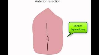 Basics of colorectal operations [upl. by Undis]