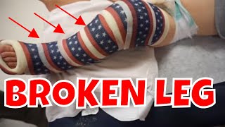 BROKEN LEG vlog Getting a cast on 😱 [upl. by Idden]