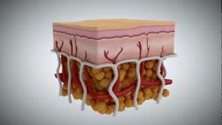 Cellulite What It Is What Causes It and How to Treat It [upl. by Brill]