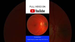 Choroidal Nevus Fundoscopy [upl. by Harneen513]