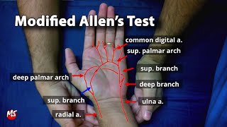 Modified Allens test [upl. by Koser]