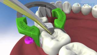 Class II composite restoration using V3 Sectional Matrix System  Triodent [upl. by Heintz409]