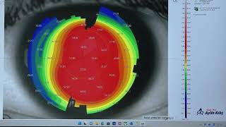 Keranatural  Cairs Treatment With Istanbul Nomogram For Keratoconus [upl. by Lesna]