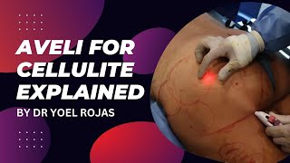 AVELI FOR CELLULITE EXPLAINED BY DR YOEL ROJAS [upl. by Nicki895]