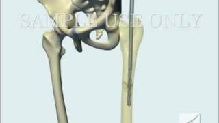 Femoral Fracture Fixation Surgery Intramedullary Nail [upl. by Elfrida]