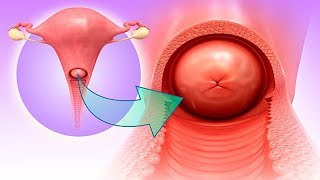 ¿La cervicitis crónica es CÁNCER [upl. by Debarath]